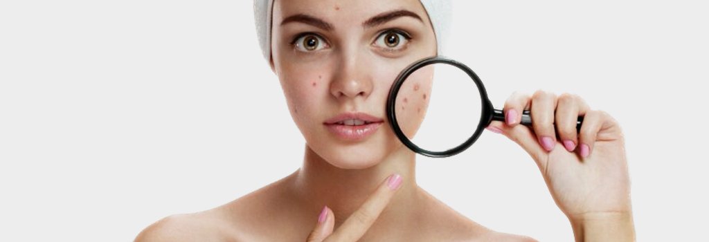 ทรีทเม้นท์สิว ทรีทเม้นท์รักษาสิว